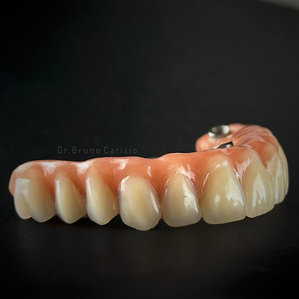 Foto 3 de Dentista - Dr. Bruno Carisio - Lentes de Resina e Implantes