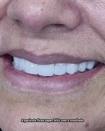 Foto 3 de Dentista Dr. Cesar Ferraz / Lentes de Resina e Porcelana / Brasilia-DF