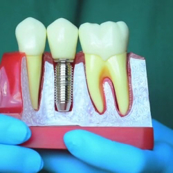 Foto 4 de Dentista Dr Fausto Queiroz I Implante Dentário em Salvador