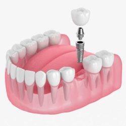 Foto 5 de Dentista Dr Fausto Queiroz I Implante Dentário em Salvador