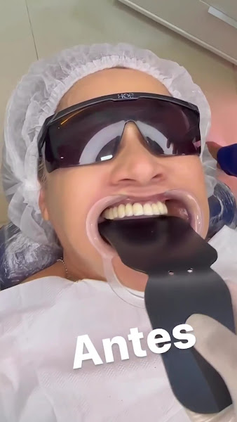 Foto 5 de Dentista Dr. Fernando Brasil | Odontologia de Alto Impacto| Lentes de Contato Dental | Implantes Dentários