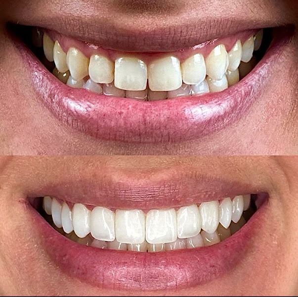 Foto 2 de Dentista Dr Hiago Oliveira - Lentes e Implantes