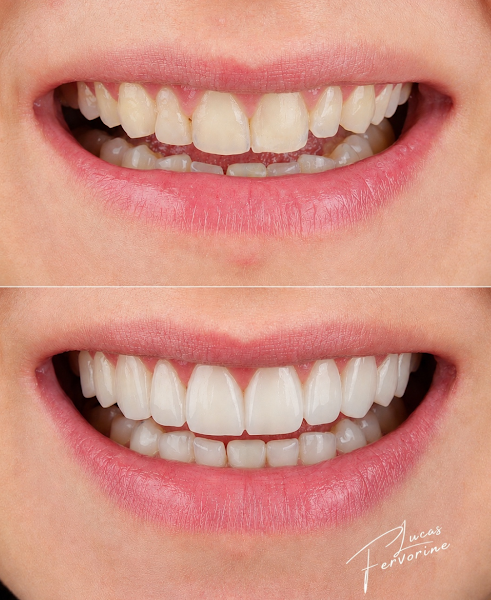 Foto 2 de Dentista - Dr. Lucas Fervorine | Lentes em Resina