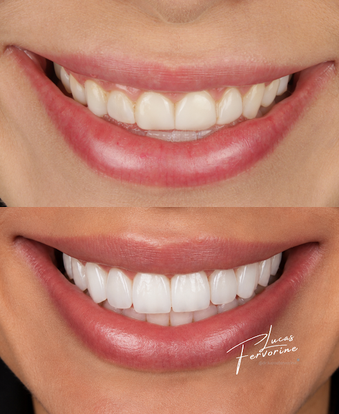 Foto 3 de Dentista - Dr. Lucas Fervorine | Lentes em Resina
