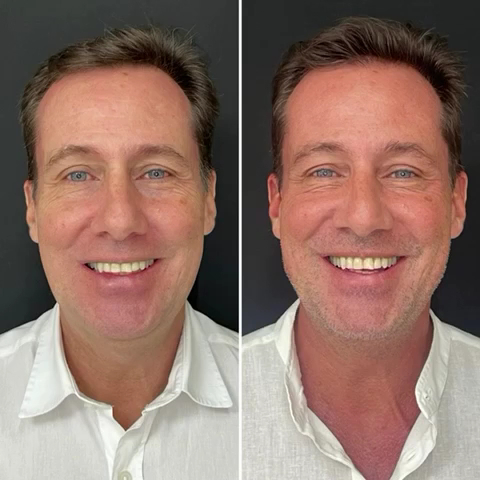 Foto 3 de Dentista Dr. Vinicius Falcão I Implantes Indaiatuba