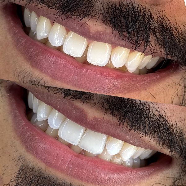 Foto 3 de Dentista Dra.Monara Marie | Lentes em Resina e Porcelana