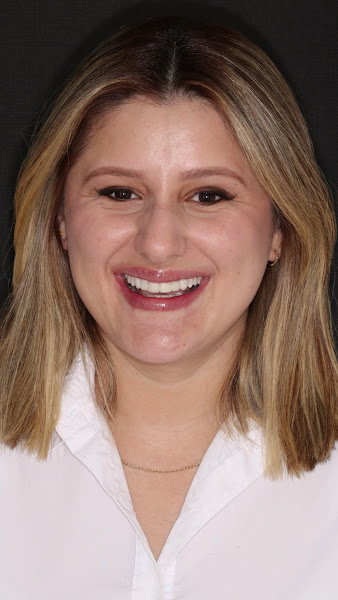 Foto 3 de Dentista Dra. Nágila Lessa - Estética Dental - Facetas de Resina