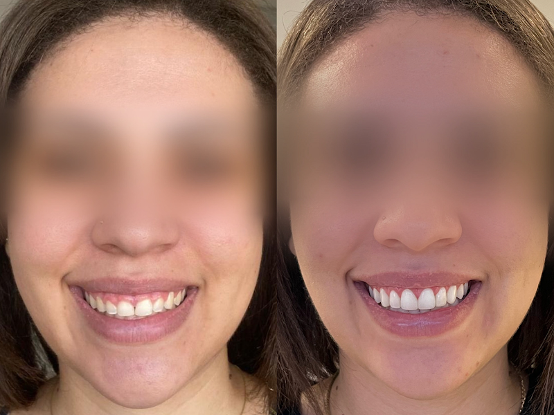 Foto 8 de Dentista em Bauru: AM odontologia- Dra. Ana Menezes | Ortodontista / Facetas de resina