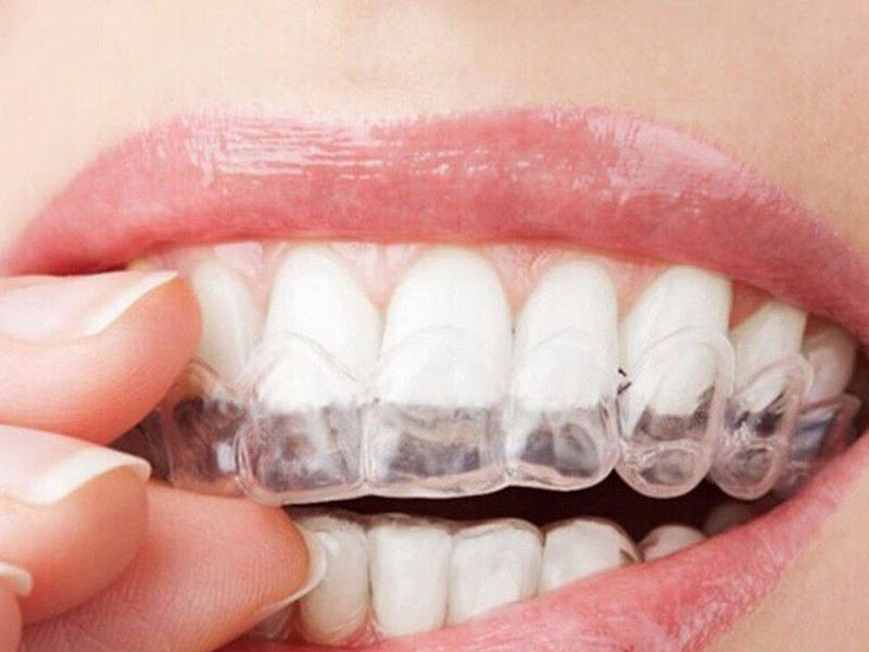 Foto 9 de Dentista em Bauru: Dr. Bruno Trevizo - Implantes Dentários, Protocolos e Cirurgia de Sisos