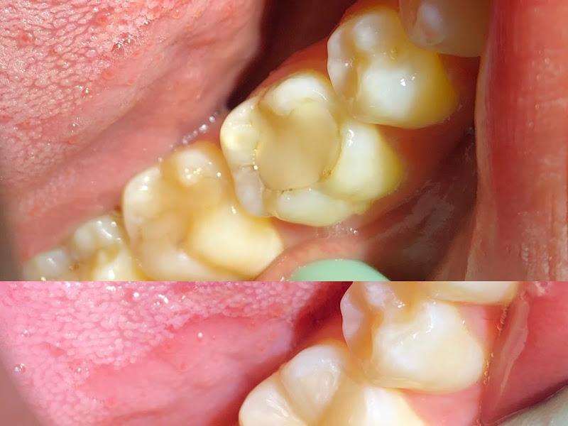 Foto 3 de DENTISTA EM TANGARÁ DA SERRA | ODONTOVIDA | IMPLANTE | ORTODONTIA | ENDODONTIA | CLAREAMENTO | CIRURGIA | PROTESE | UNIVIDA