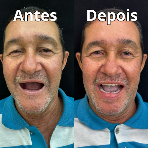 Foto 2 de Dentista Iapep - Dr Luis Dias- Implante dentário e Cir Siso. Bucomaxilo Plamta (Cir. Ortgnática, Fraturas de face, DTM).