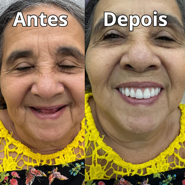 Foto 3 de Dentista Iapep - Dr Luis Dias- Implante dentário e Cir Siso. Bucomaxilo Plamta (Cir. Ortgnática, Fraturas de face, DTM).