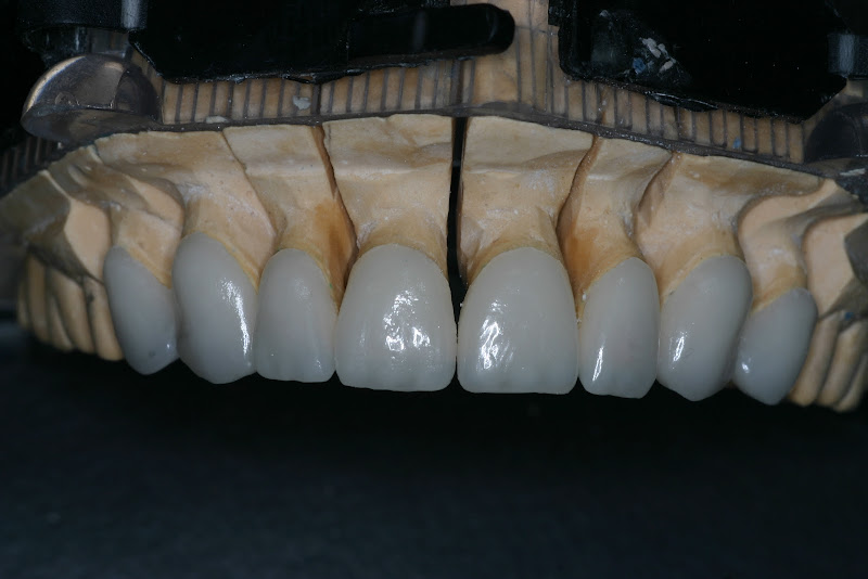 Foto 3 de Dentista Ilha Do Governador - Dr. Estácio De Sá - PRÓTESE - IMPLANTE - REABILITAÇÃO ESTÉTICA - ORTODONTIA - ENDODONTIA