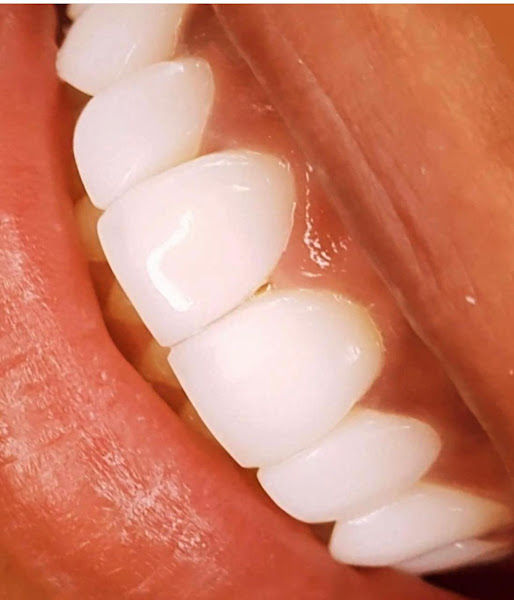 Foto 2 de Dentista Interlagos / Lentes em Resina / Odontologia Vicentini