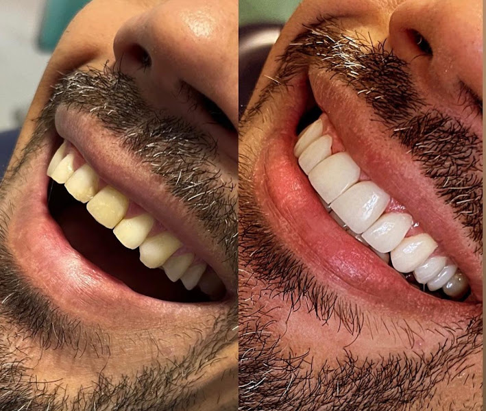 Foto 3 de Dentista Interlagos / Lentes em Resina / Odontologia Vicentini