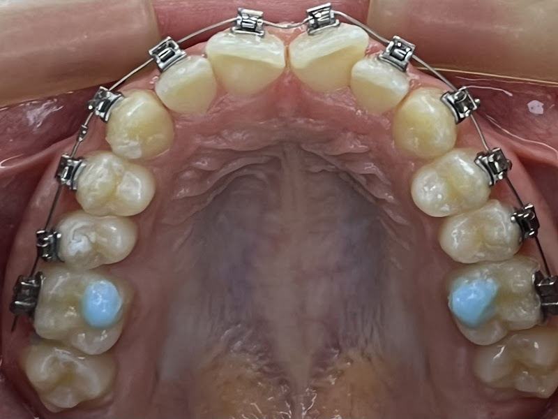 Foto 8 de Dentista Juliana Mateus | Bruxismo | Dor orofacial | Invisalign | Clareamento dental 🪥🦷