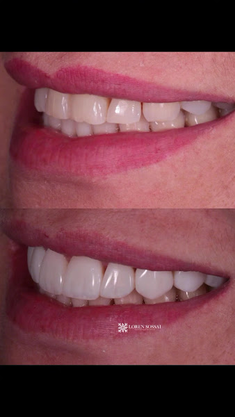 Foto 4 de Dentista Loren Sossai | Facetas | Lentes em Resina