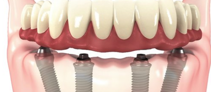 Foto 2 de Dentista Madureira Clinica Vida Odontologia e Estética