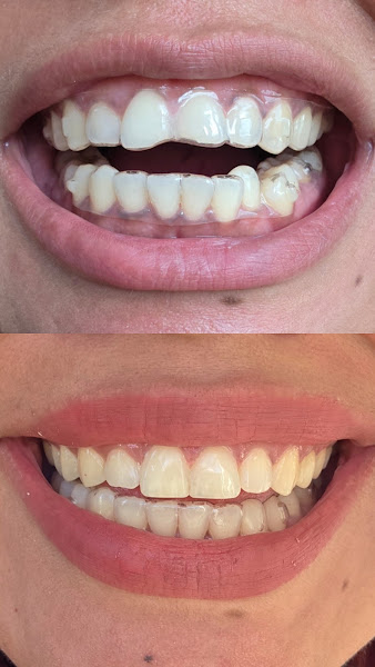 Foto 2 de Dentista Manaus Ponta Negra/Dr. Gabriel Cardoso/SouSmile/Alinhador invisível