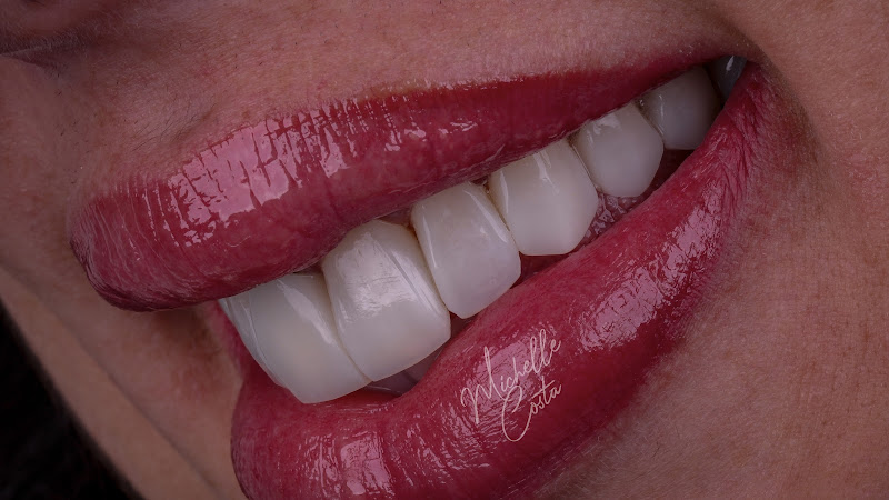 Foto 2 de Dentista Michelle Costa | Lentes de Contato Dental e Facetas em Resina no Rio de Janeiro – Barra da Tijuca e Madureira