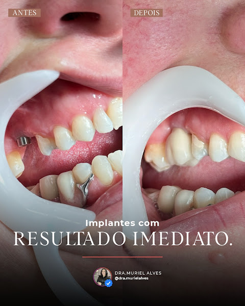 Foto 2 de Dentista no Tatuapé | Dra. Mouriel Alves - Implantes, Lentes de Resina, Grillz e Clínico Geral