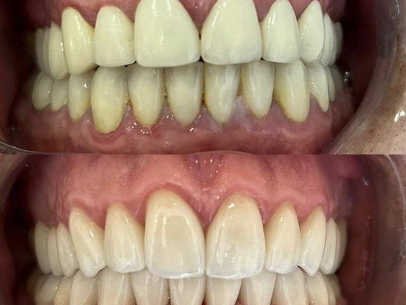 Foto 3 de Dentista Pinheiros Dr Wanier Bucomaxilo SP, Implante Dental Unitário, Clareamento, Bichectomia, Cirurgia Ortognatica