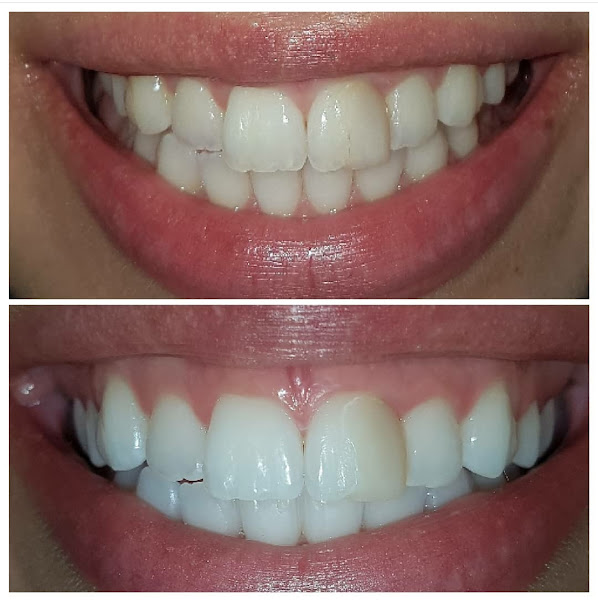 Foto 2 de Dentista Prótese | Ronco | Apneia - Uberlândia MG - Dra Merielle Rezende