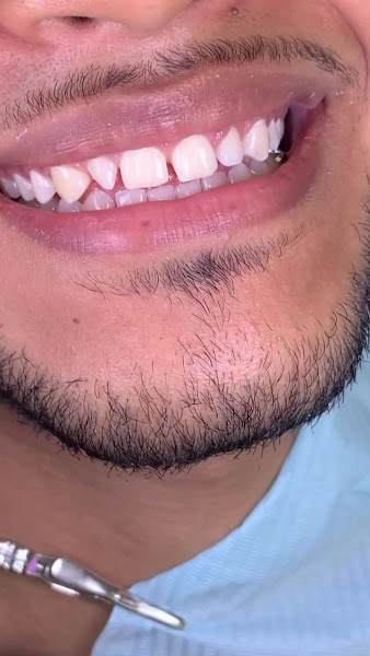 Foto 4 de Dentista Rafaela Lopes - Lente de Contato Dental em Salvador - Lentes de Resina Valor facetas