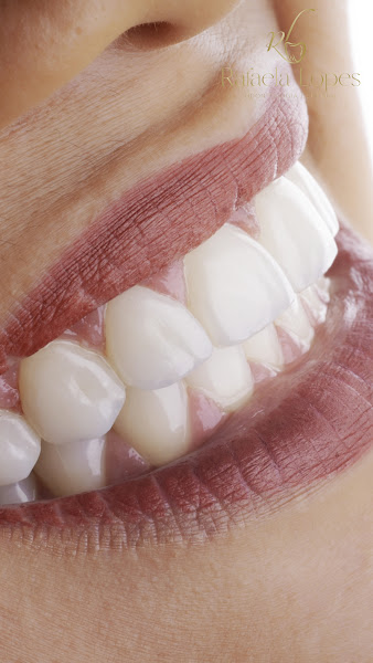 Foto 5 de Dentista Rafaela Lopes - Lente de Contato Dental em Salvador - Lentes de Resina Valor facetas