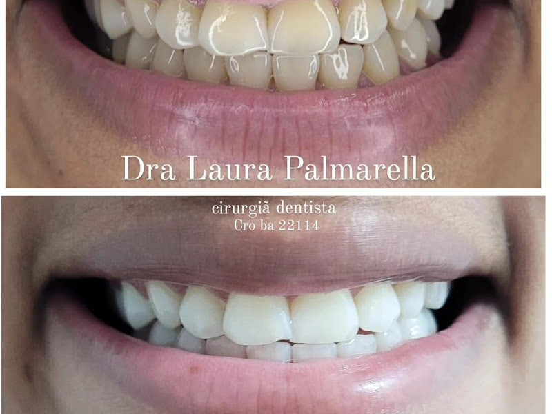 Foto 8 de Dentista Rafaela Lopes - Lente de Contato Dental em Salvador - Lentes de Resina Valor facetas