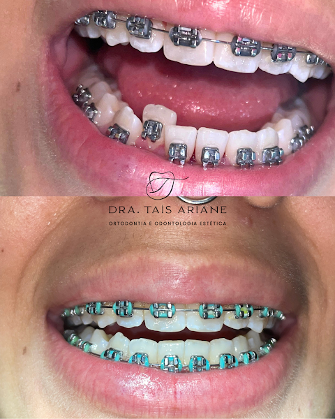 Foto 3 de Dentista Recreio dos Bandeirantes | Ortodontista | Consultório Odontológico Dra. Taís Ariane |