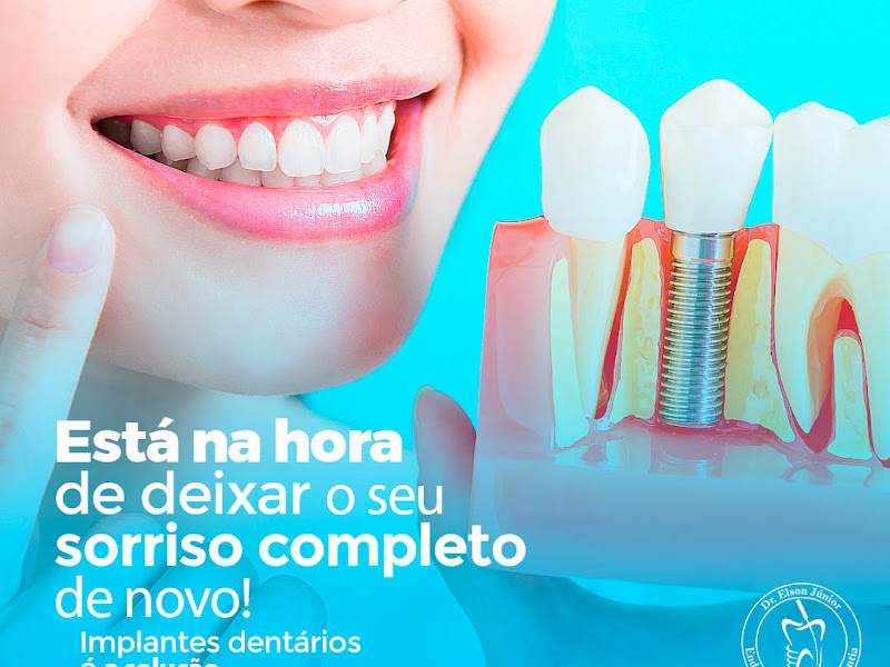 Foto 3 de Dentista Rio Branco Dr Elson Júnior | Dentista 24h | Lente de Contato Dental | Implante Dentário