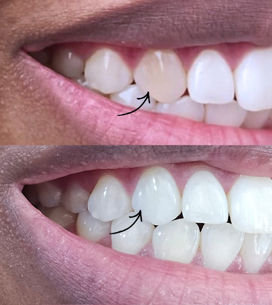 Foto 2 de DENTISTA (VENDRAME ODONTOLOGIA ESPECIALIZADA) -Dra. Michele Vendrame
