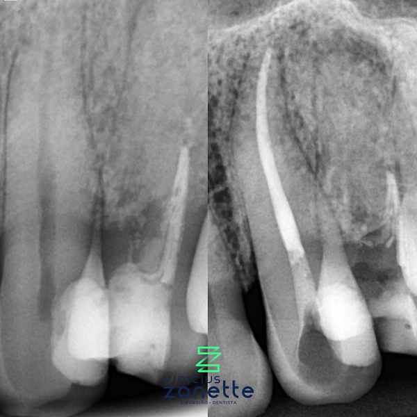 Foto 3 de Dentista Vinícius Zanette / Especialista na em Endodontia