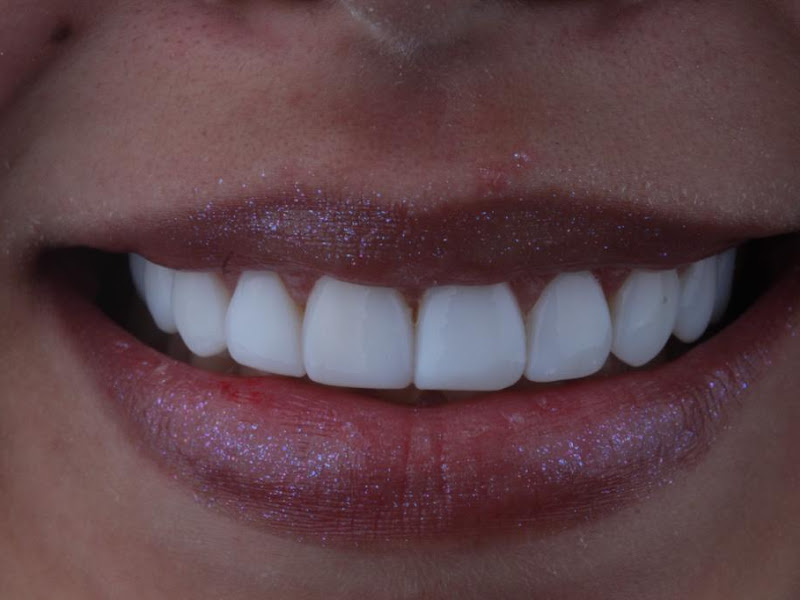 Foto 2 de Dentistas Lente de Resina Restore