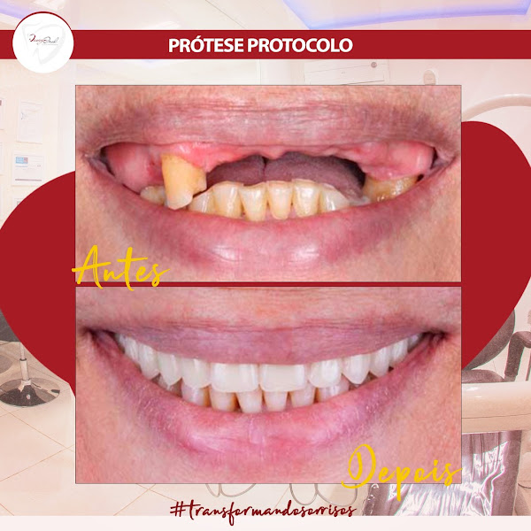 Foto 3 de Design Oral: Dentista, Facetas, Clareamento, Implantes, Próteses em Cascavel PR