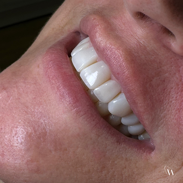 Foto 2 de Doutor Lucas Torok Odontologia - Lentes de Resina e Lente de Contato Dental