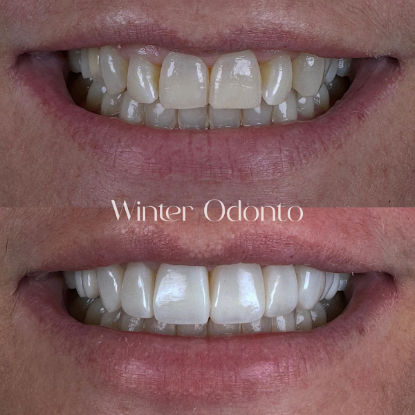 Foto 3 de Doutor Lucas Torok Odontologia - Lentes de Resina e Lente de Contato Dental