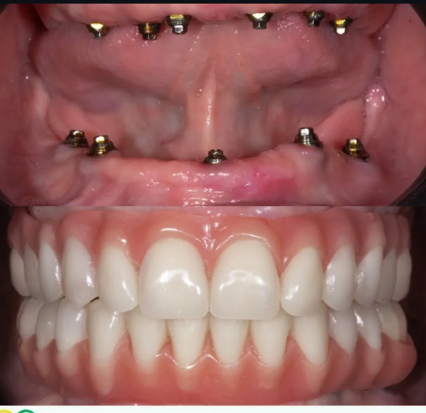 Foto 3 de Dr Ademar Ítalo Soares Implante Dentário.