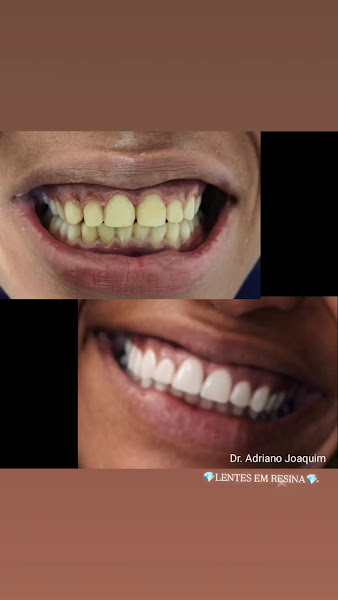 Foto 3 de Dr. Adriano Joaquim – Ortodontia e Facetas Dentárias em São José