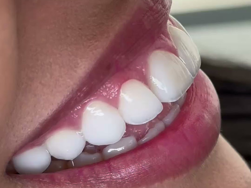 Foto 3 de Dr. Alex Martins - Referência em Lentes de Porcelana e Facetas em Resina