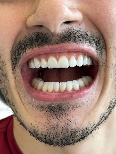 Foto 3 de Dr. Alexandre Vaz, Dentista no Centro de Guarulhos - Tratamento de Canal, Endodontia, Prótese Dentária, Clareamento Dental