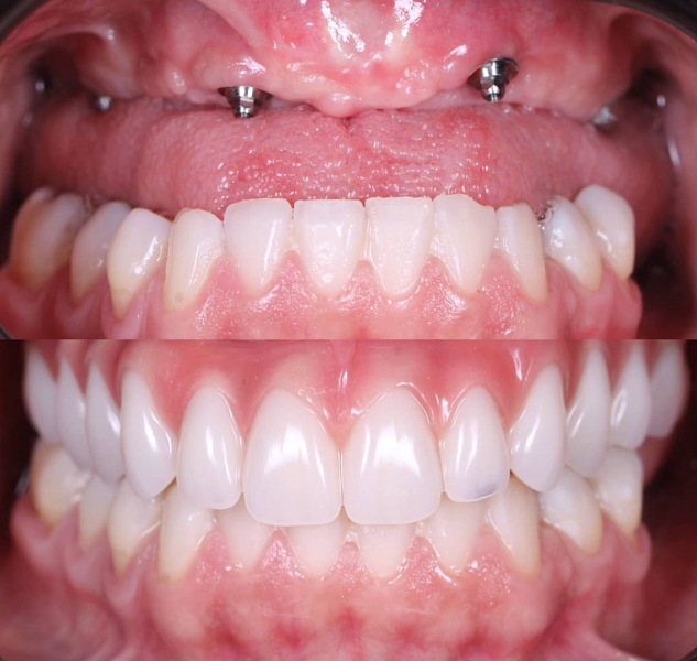 Foto 3 de Dr. Álvaro Melo | Especialista em Prótese Protocolo | Implantes Dentários em Barreiras