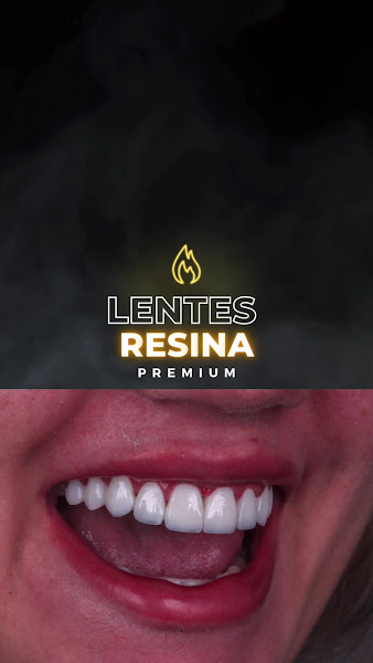Foto 2 de Dr. Anderson Brasil Lentes e facetas em resina dental premium