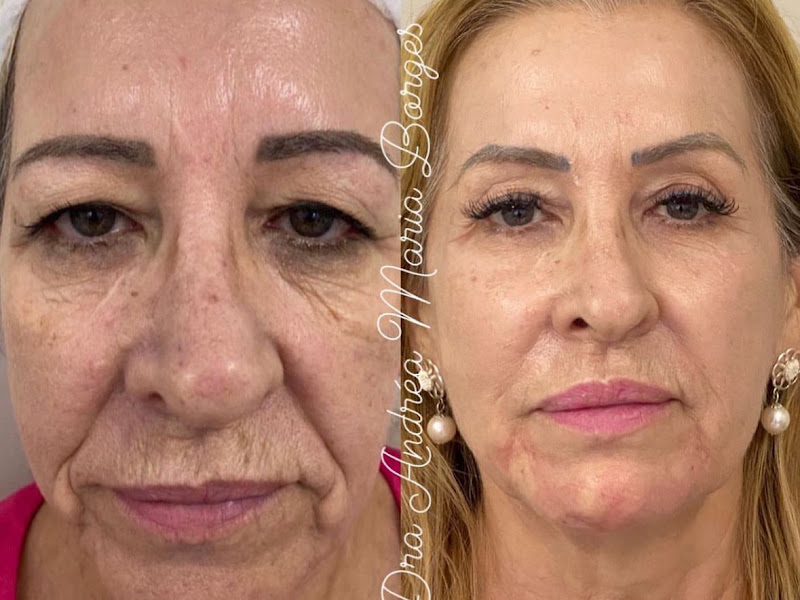 Foto 3 de Dr. Anderson Brasil Lentes e facetas em resina dental premium