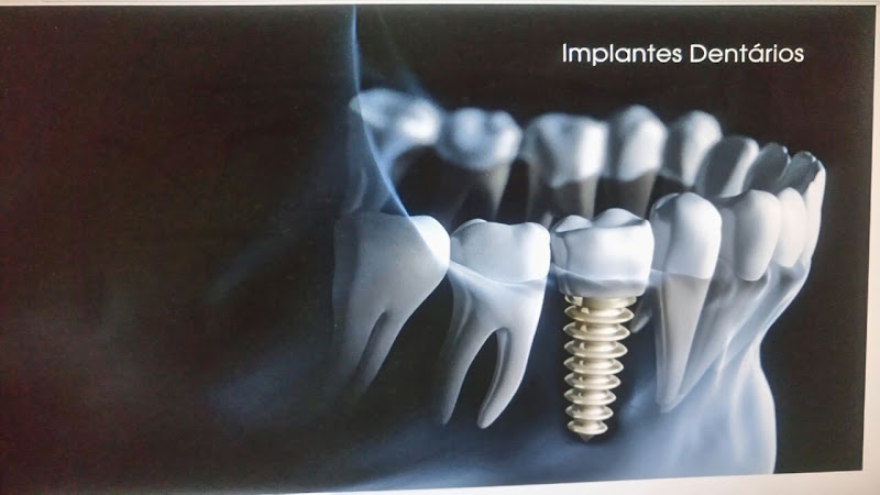 Foto 3 de Dr. Anderson Claussen / Implante dentário