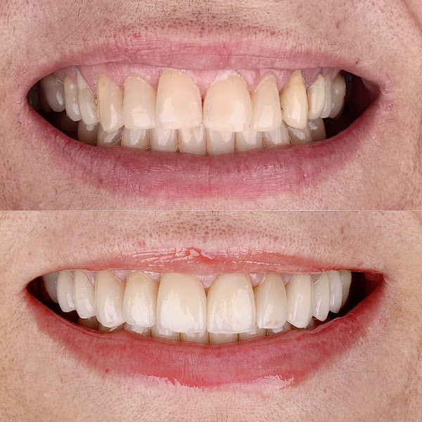 Foto 3 de Dr. Andress Schneider - Lentes de Contato Cerâmicas