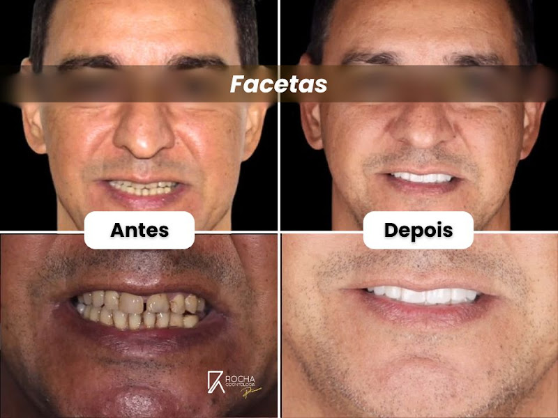 Foto 3 de Dr. Antônio Carlos Rocha Dentista | | Facetas de Resina em Americana