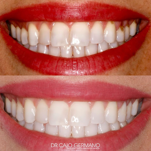Foto 3 de Dr. Caio Vinícius Rodrigues Germano | Implante Dentário | Harmonização Facial | Lente de Contato Dental