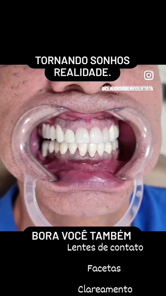 Foto 3 de Dr. Cláudio Ribeiro -odontologia de Qualidade | Implantodontia, Canal, Próteses ,cirurgia ,reabilitação oral, dtm.